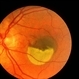Subretinal neovascular membrane Subretinal neovascular membrane